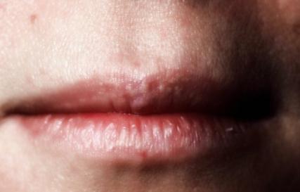 Weißer Fleck auf der Innenseite der Lippe